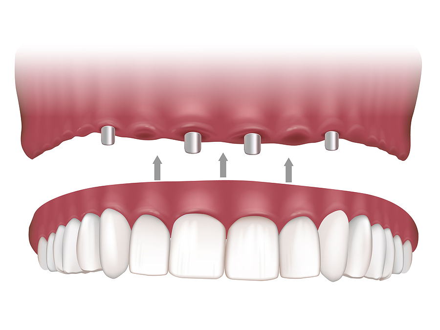 Restore Your Smile with All-on-4 / Hybrid Dentures: A Permanent Solution for Missing Teeth