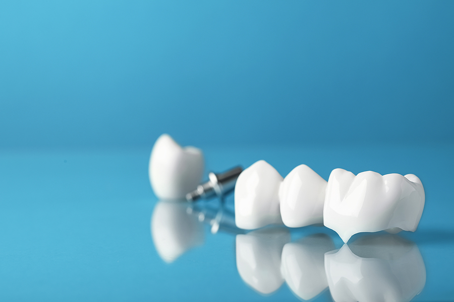 Restore Your Smile with Crown & Bridge Treatments in San Francisco, CA