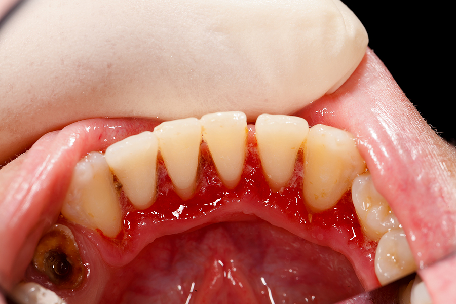 Comprehensive Guide to Gum Treatment: Steps to a Healthier Smile