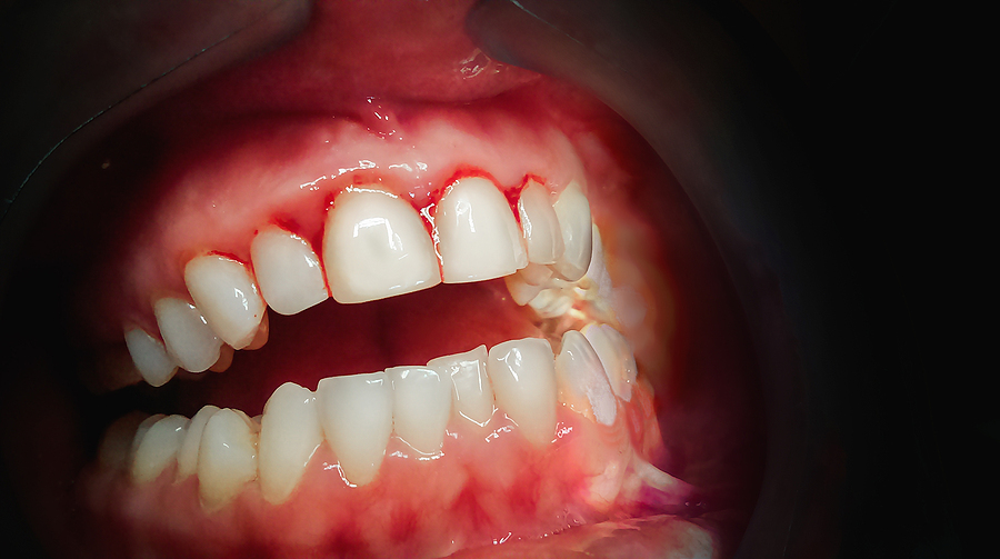 Effective Gum Treatment for a Healthier Smile in San Francisco, CA