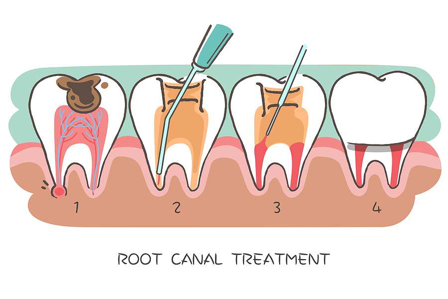 Understanding Root Canals: A Lifesaving Treatment for Your Teeth